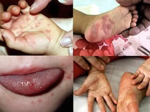 Sốt xuất huyết tăng 2,2 lần, tay chân miệng gấp 5 lần