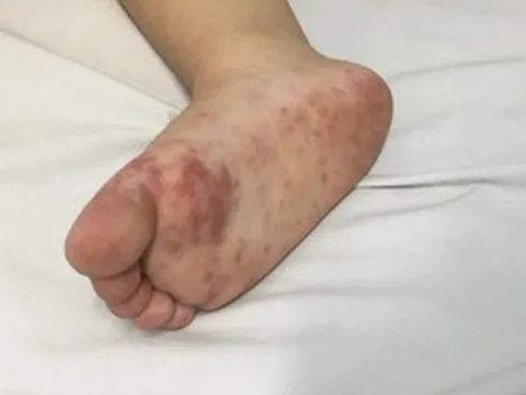 Dịch tay chân miệng “nóng” trở lại, trẻ nhỏ đối mặt nguy cơ biến chứng nặng