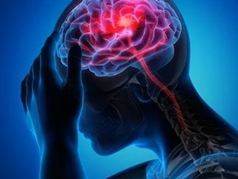 Nghiên cứu 53.000 người chỉ ra 3 cách ngăn ngừa đột quỵ đơn giản