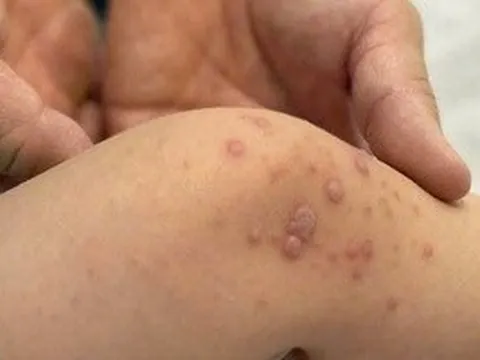 Bệnh tay chân miệng tăng nhanh, bác sĩ cảnh báo nóng