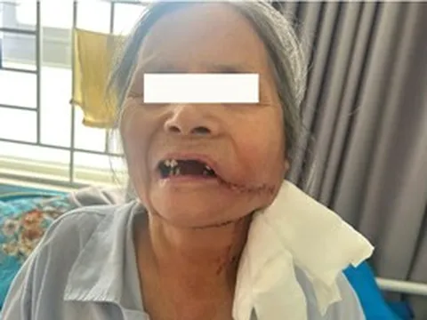 Phát hiện ung thư từ một vết loét ở miệng