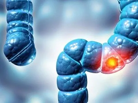 Phát hiện virus mới liên quan loại bệnh ung thư phổ biến