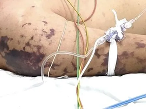 4 ca tử vong do não mô cầu, Bộ Y tế cảnh báo nguy cơ