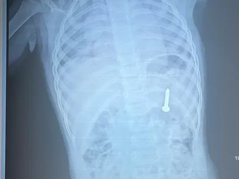 Đang chơi ở nhà, bé gần 2 tuổi nuốt phải thứ "đáng sợ"