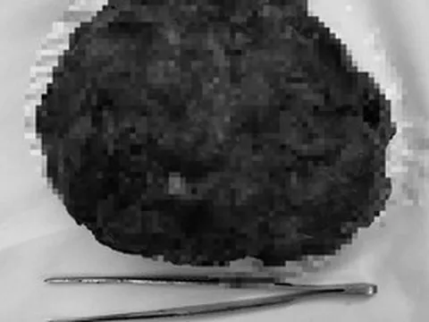 Cô gái trẻ về nước mổ u vú 17 cm, giữ được “vòng một”