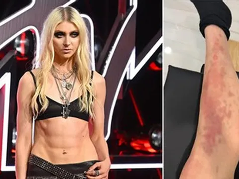 Nữ ca sĩ 33 tuổi nhập viện cấp cứu vì bị nhện độc cắn