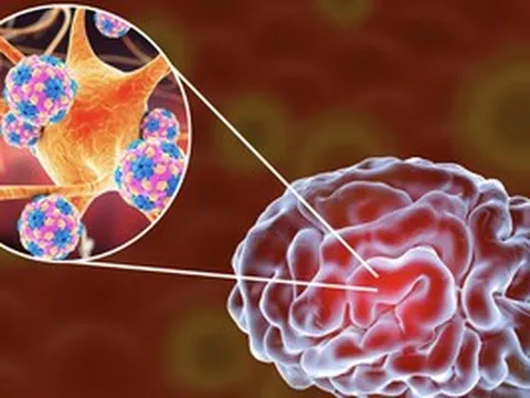 Bệnh nhi 2 tuổi bị viêm não mô cầu đã không qua khỏi