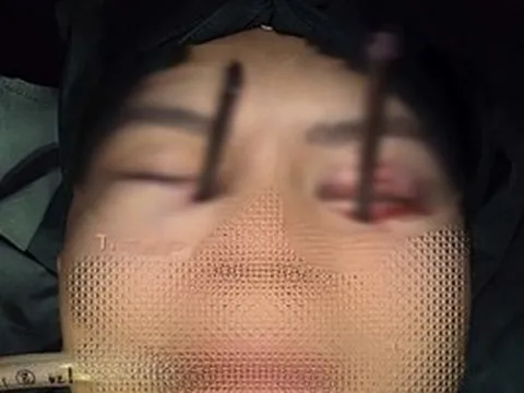 Cứu nam thanh niên bị 2 chiếc đũa đâm sâu vào 2 hốc mắt