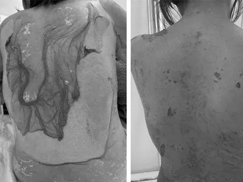 Người phụ nữ 35 tuổi sốc khi da bị tróc như "cua lột"