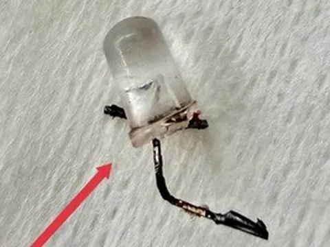 Bác sĩ thót tim gắp đèn LED nằm trong phế quản bé 9 tháng tuổi