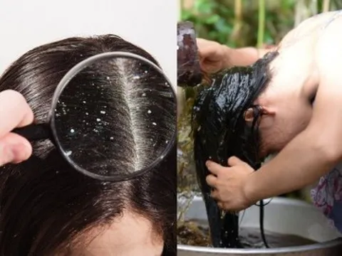 Gội đầu liên tục mà gàu vẫn tróc từng mảng, thử áp dụng những công thức tự nhiên này