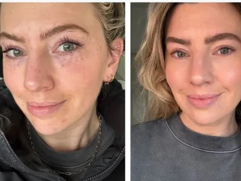 Cơn sốt trẻ hóa từ chiết xuất tinh dịch cá hồi 'làm mưa làm gió' thị trường thẩm mỹ