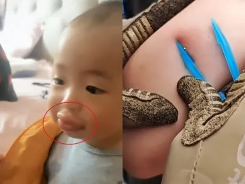 Con đi chơi bị ong đốt khiến môi sưng vù, người mẹ cứu sống con trong 20 phút, bác sĩ khen: Giỏi lắm!