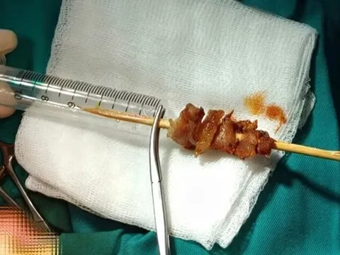 Bé 2 tuổi gặp sự cố nguy hiểm với que xiên thịt trong lúc chạy nhảy