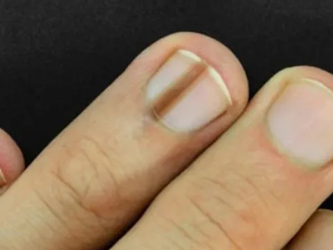 6 bất thường trên móng tay có thể đang “tố cáo” bệnh trong cơ thể bạn