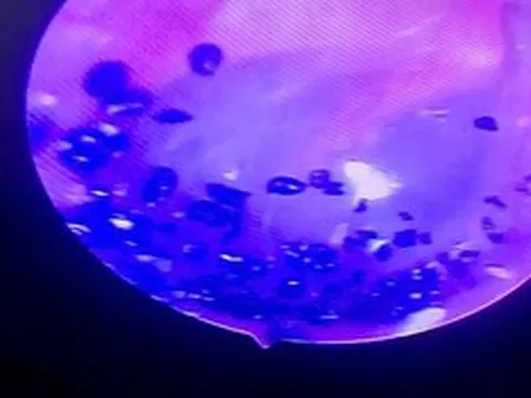 Bé 7 tuổi đau tai dữ dội, gia đình "sốc" khi bác sĩ kéo ra thứ "đáng sợ" không ngờ tới