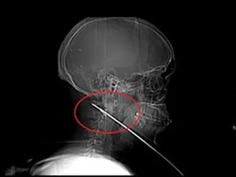 Nhập viện vì đau bất thường, nam bệnh nhân 27 tuổi khiến bác sĩ "sốc" khi lấy ra thứ không ngờ tới