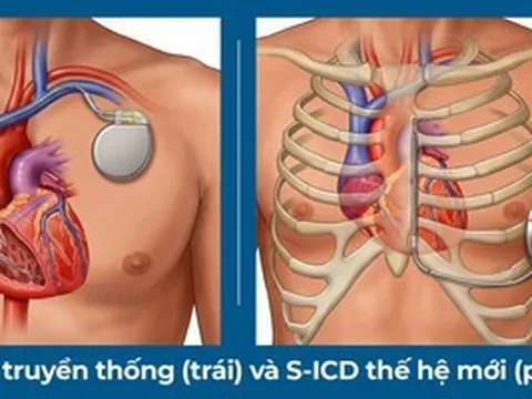 Lần đầu tiên đặt máy phá rung tim công nghệ mới