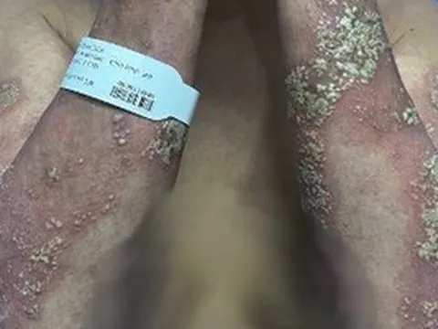 Da tổn thương toàn thân vì đợt bùng phát vảy nến hiếm gặp