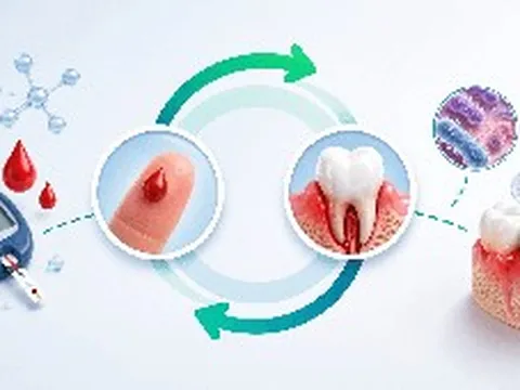 58% người mắc tiểu đường bị bệnh nha chu: Đừng xem nhẹ dấu hiệu chảy máu chân răng
