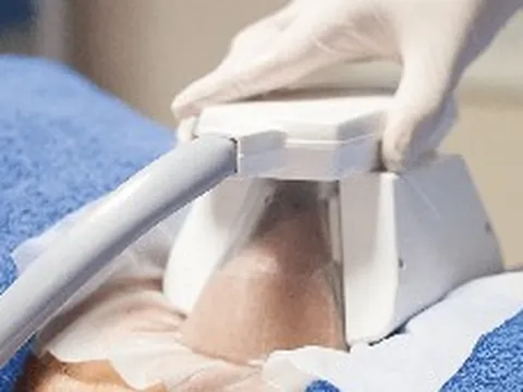 Chỉ cần nằm một giờ, mỡ sẽ tự biến mất? Sự thật phía sau công nghệ "đông lạnh mỡ" đang phủ kín TikTok
