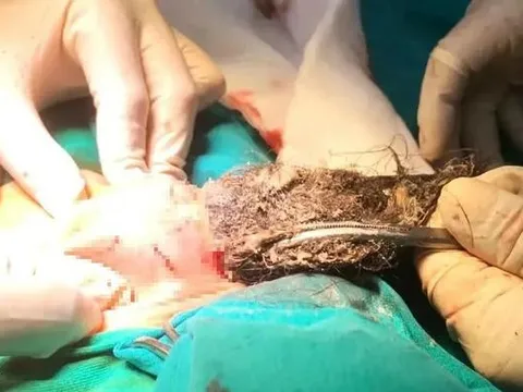 Phẫu thuật lấy búi tóc dài gần 20cm trong dạ dày bé trai 4 tuổi, do bé mắc bệnh lạ