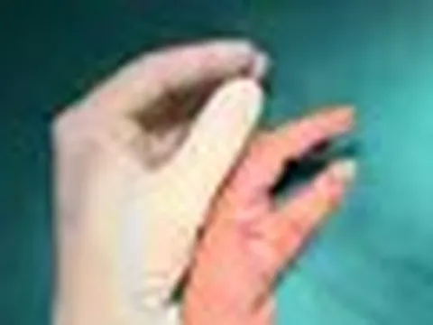 Biến ngón trỏ thành ngón cái: Phép màu y học giúp bé gái 5 tuổi tự cầm đũa, viết chữ