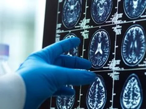AI lần đầu hỗ trợ mổ não trực tiếp trên người: Cuộc thử nghiệm có thể thay đổi cách bác sĩ phẫu thuật