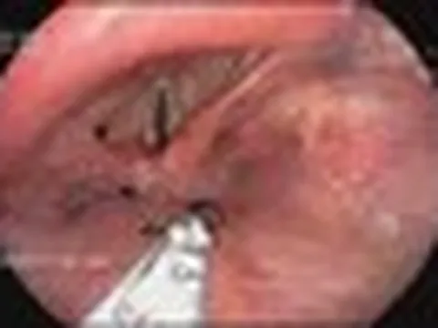 Đàn kiến chui vào thanh quản người đàn ông