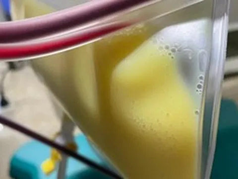 Người phụ nữ 30 tuổi "máu trắng đục như sữa" vì thói quen nhiều người mắc mà không hay