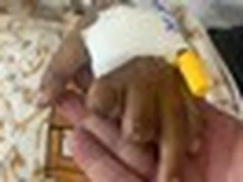 Bé trai 10 tuổi sáng đau đầu, chiều hôn mê và xuất hiện tử ban vì não mô cầu: "Tối đó chuyển lên Nhi Đồng Thành Phố, nhưng em không qua khỏi"