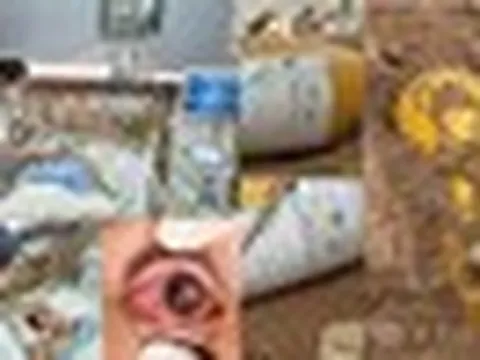 Vụ rò rỉ khí clo ở Hà Nội: Bệnh viện Bạch Mai hội chẩn khẩn cấp cứu chữa 7 nạn nhân, 2 ca rất nặng, một người phải can thiệp ECMO