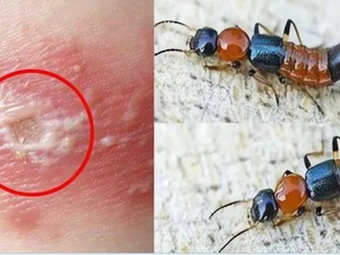 Kiến ba khoang "vào mùa", cẩn trọng dễ nhầm với zona thần kinh