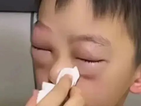 Mẹ hốt hoảng vì mắt con sưng to như quả trứng gà, nguyên nhân phía sau ai cũng "dở khóc dở cười"